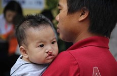 Cleft lip, palate surgeries offered free of charge