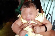 Vietnam confirms first Zika-tied birth defect case 
