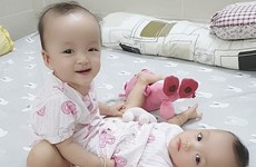 International press highlights operation to separate conjoined twins in Vietnam