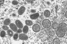 Vietnam announces first case of monkeypox