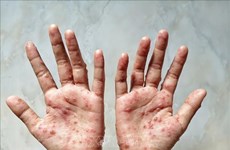 Laos detects first monkeypox case 