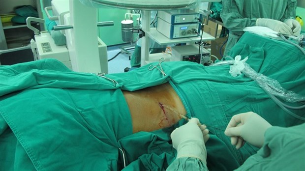 HCM City surgeons remove giant kidney stone hinh anh 1