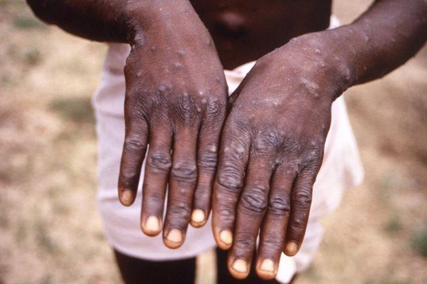 Singapore detects first case of rare monkeypox hinh anh 1