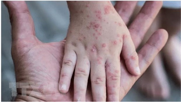Vietnam monitors arrivals from countries with monkeypox hinh anh 1