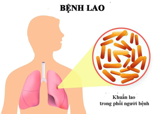 PM calls to boost anti-tuberculosis efforts hinh anh 1